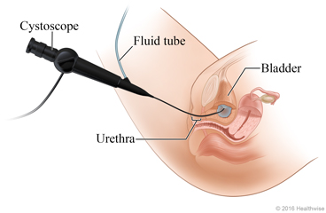 Cytoscope placement through urethra into bladder