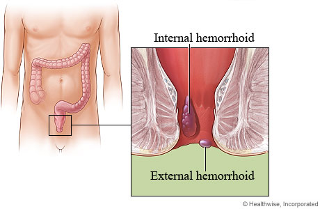 Internal and external hemorrhoids.