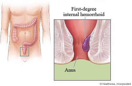 First-degree internal hemorrhoid.