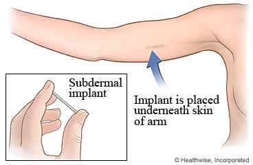 Picture of the subdermal implant in a woman's arm
