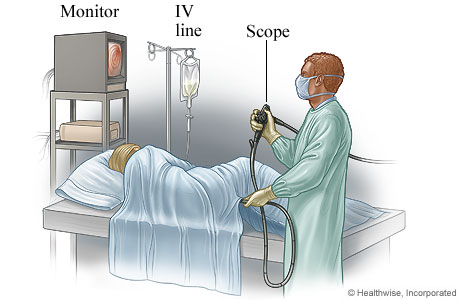 A person having a sigmoidoscopy.