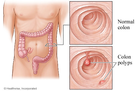 Colon polyps and the location of the colon.