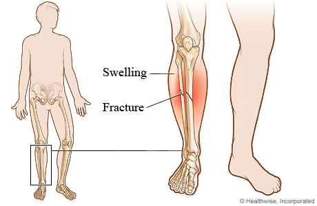 Lower leg fracture.