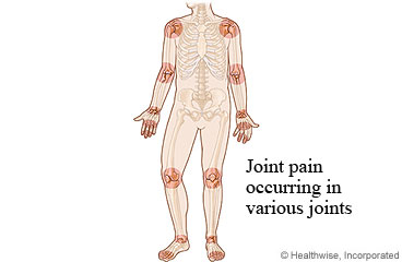 Picture of joint pain regions associated with rheumatoid arthritis