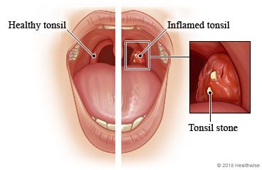 Healthy tonsil versus inflamed tonsil, with detail of tonsil stone
