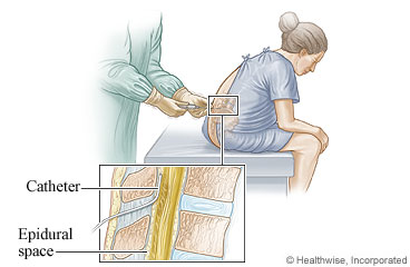 Placement and position of an epidural catheter