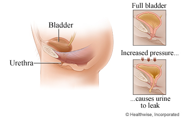 Location of bladder and urethra in the body, with detail of full bladder causing urine to leak