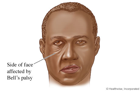Facial muscles affected by Bell's palsy.