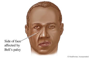 Affected side of a man's face with Bell's palsy