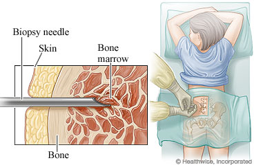 Picture of the face down position for a bone marrow aspiration and biopsy