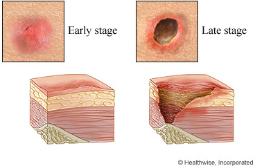 Early stage and late stage pressure sores.
