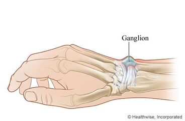 Picture of dorsal wrist ganglion