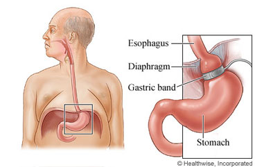 Esophagus and stomach, with a detail of the esophagus,diaphragm, gastric band, and stomach