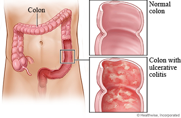 A normal colon and one with ulcerative colitis