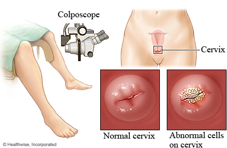 Colposcope and cervix.