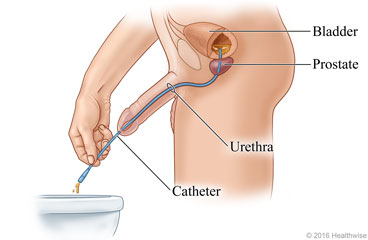 Man draining urine from bladder into toilet using catheter inserted into urethra