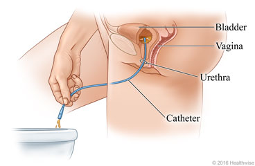 Woman draining urine from bladder into toilet using catheter inserted into urethra