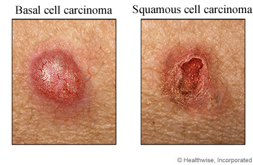 Two types of skin cancer
