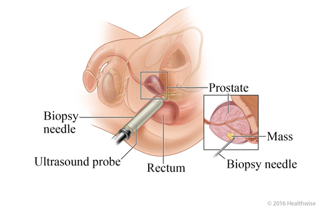 Transrectal prostate biopsy.
