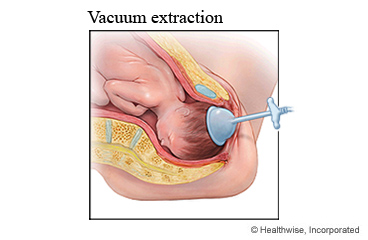 Vacuum extraction