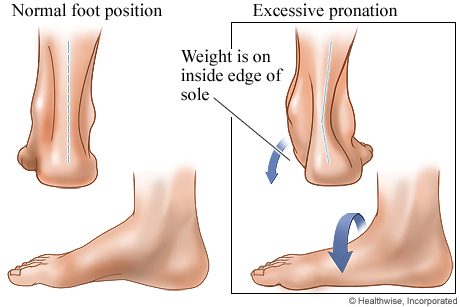Normal foot position and excessive pronation.