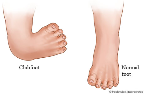 Clubfoot and normal foot.