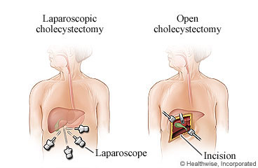 Gallbladder removal (cholecystectomy) showing laparoscopic type with small incisions in the chest and open type with one large incision in the chest