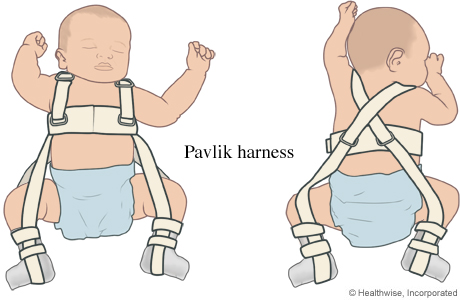 Pavlik harness on a baby.