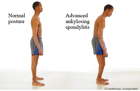 Normal posture compared to the posture of advanced ankylosing spondylitis.