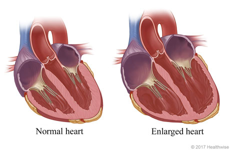 Cross section of a normal heart and a heart with enlarged chanbers
