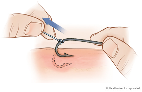 String-pull method for removing a fish hook