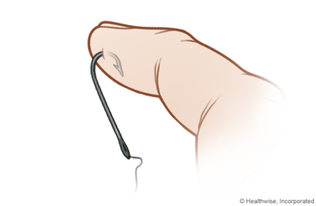 Finger Fishhook Emergency and Needle Barb Release Technique 