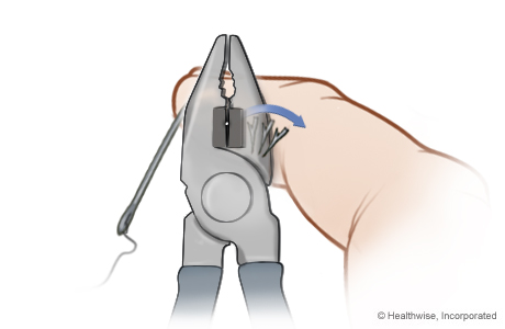 Advance-and-cut method of fish hook removal