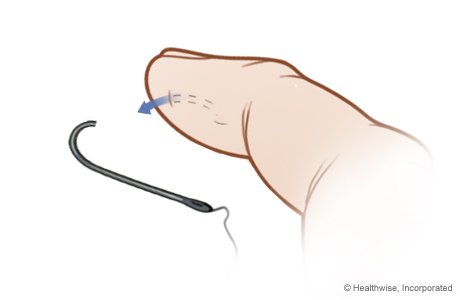 Advance-and-cut method of fish hook removal