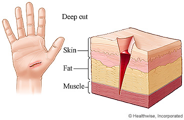 Deep cut through the layers of the hand