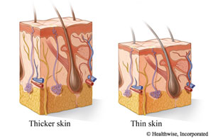 Drawings of a cross section of thicker skin and thinner skin.