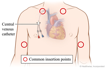Areas on upper arms and upper chest where catheter may be put in