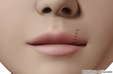 Lip laceration with stitches