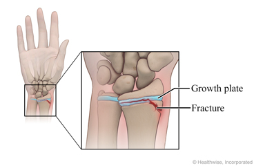 Growth plate fracture in the lower arm