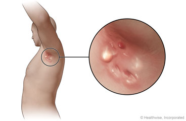 Hidradenitis suppurativa in the armpit, with close-up view of the lumps