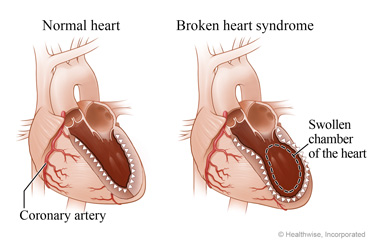 A normal heart showing a coronary artery and a normal chamber, and a heart with broken heart syndrome showing a swollen chamber