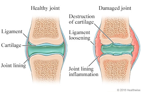 Healthy joint compared to a damaged joint.