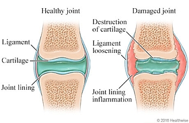 Healthy joint compared to damaged joint