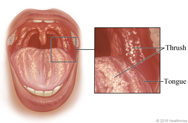 Thrush in the mouth, with close-up of thrush on tongue and inside of cheek.