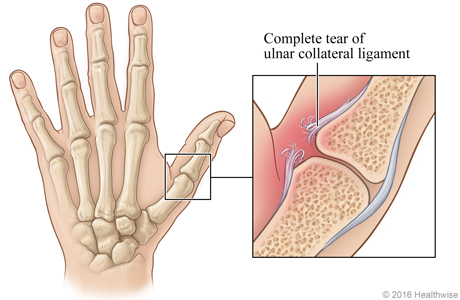 Skeletal view of hand, with detail of complete tear of ulnar collateral ligament in thumb.