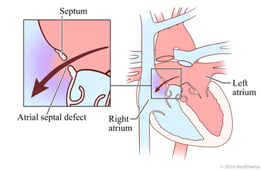 Hole in septum between left atrium and right atrium of heart, with detail of blood flow through hole