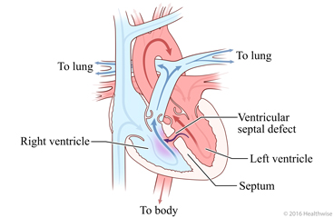 Hole in septum between right and left ventricles of heart