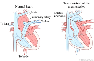 Normal heart and heart with reversal of aorta and pulmonary arteries and change in blood flow