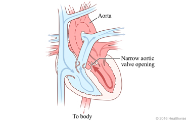Heart showing narrow aortic valve and change in blood flow
