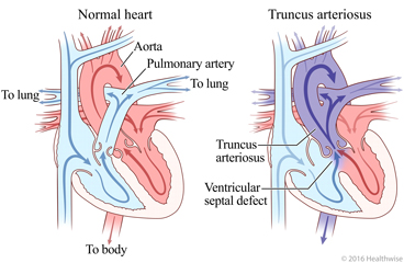 Normal heart and heart showing truncus arteriosus and change in blood flow